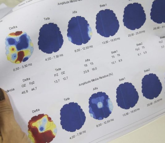 Março Roxo quer conscientizar população sobre a epilepsia