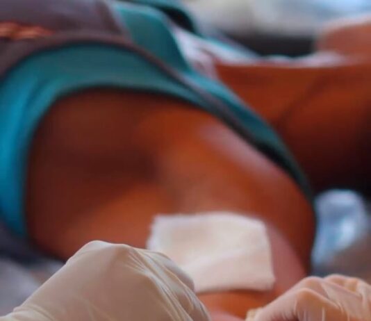 Secretaria Municipal de Saúde amplia acesso ao implante contraceptivo subdérmico para mulheres em situação de rua em Campina Grande
